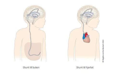 shunt i huvudet barn